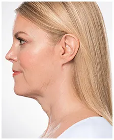 Manufacturer case photographs of Lisa F., age 54, before and after KYBELLA treatment (after)