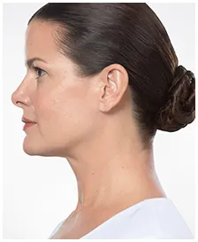 Manufacturer case photographs of Jennifer, age 44, before and after KYBELLA treatment (after)