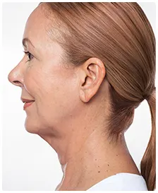 Manufacturer case photographs of Marina, age 59, before and after KYBELLA treatment (before)