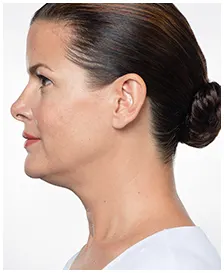 Manufacturer case photographs of Jennifer, age 44, before and after KYBELLA treatment (before)