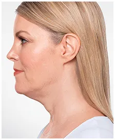 Manufacturer case photographs of Lisa F., age 54, before and after KYBELLA treatment (before)