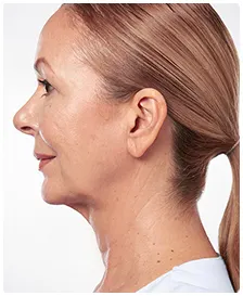 Manufacturer case photographs of Marina, age 59, before and after KYBELLA treatment (after)