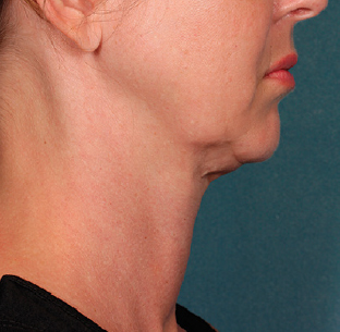 Before the first KYBELLA® treatment session.