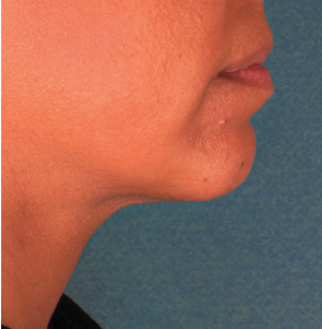 12 weeks after the final KYBELLA® treatment session.