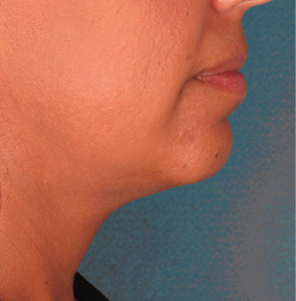 Before the first KYBELLA® treatment session.
